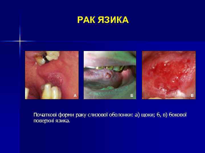 РАК ЯЗИКА А Б Початкові форми раку слизової оболонки: а) щоки; б, в) бокової