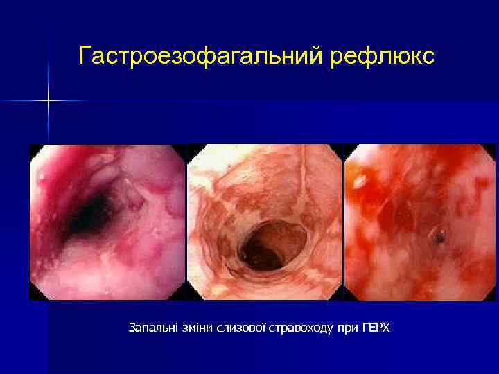 Гастроезофагальний рефлюкс Запальні зміни слизової стравоходу при ГЕРХ 