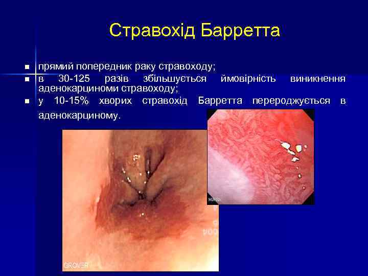 Стравохід Барретта n n n прямий попередник раку стравоходу; в 30 -125 разів збільшується