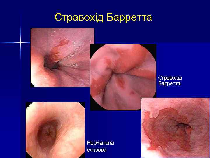 Стравохід Барретта Нормальна слизова 