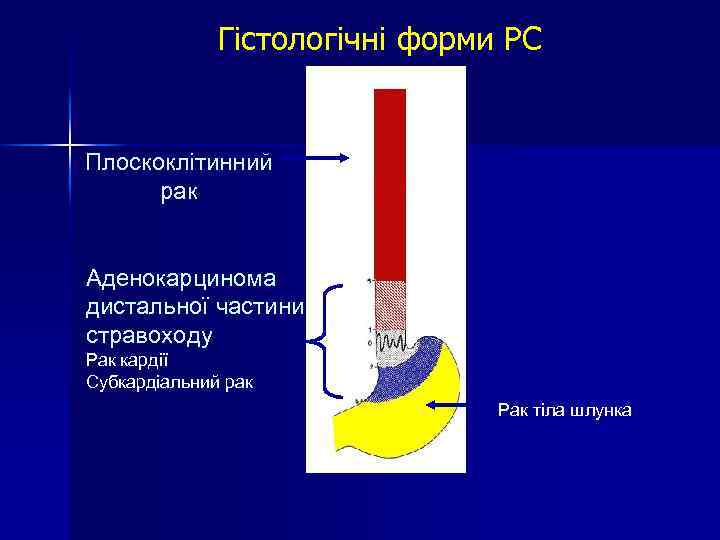 Гістологічні форми РС Плоскоклітинний рак Аденокарцинома дистальної частини стравоходу Рак кардії Субкардіальний рак Рак