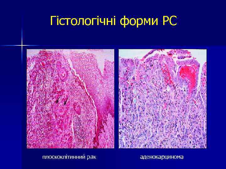 Гістологічні форми РС плоскоклітинний рак аденокарцинома 