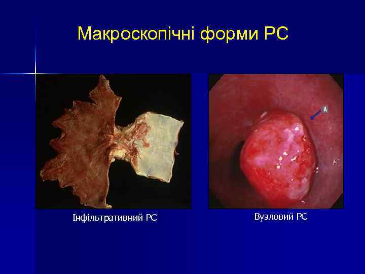 Макроскопічні форми РС Інфільтративний РС Вузловий РС 