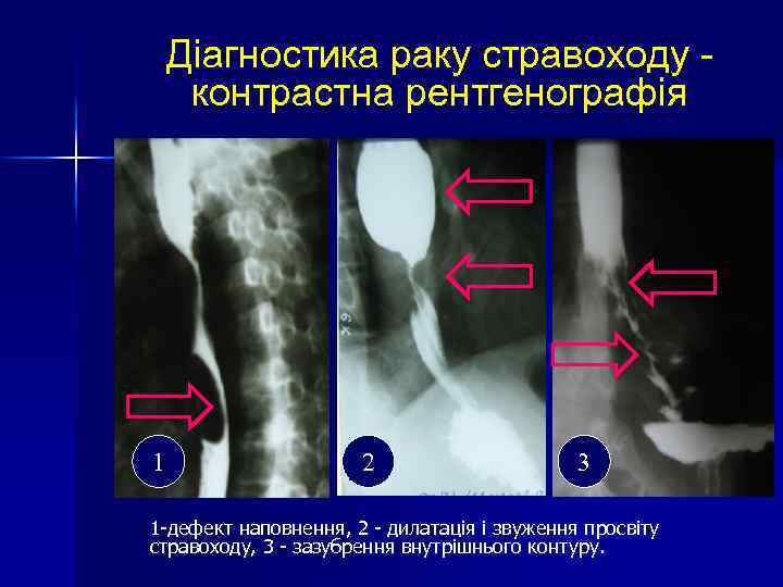 Діагностика раку стравоходу контрастна рентгенографія 1 2 3 1 -дефект наповнення, 2 - дилатація