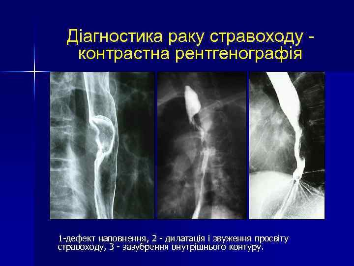Діагностика раку стравоходу контрастна рентгенографія 1 -дефект наповнення, 2 - дилатація і звуження просвіту