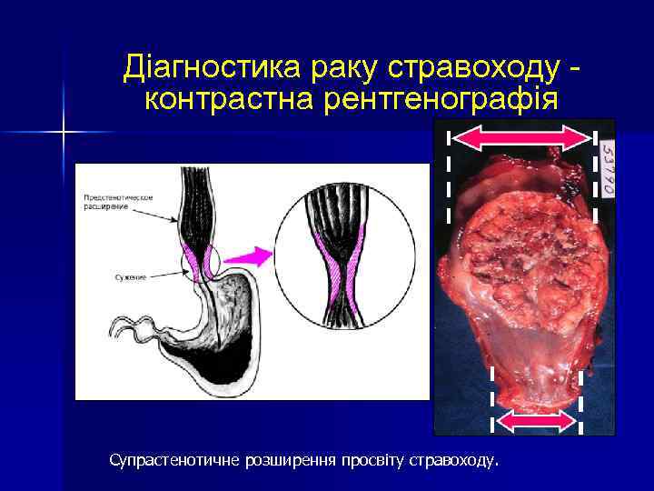 Діагностика раку стравоходу контрастна рентгенографія Супрастенотичне розширення просвіту стравоходу. 