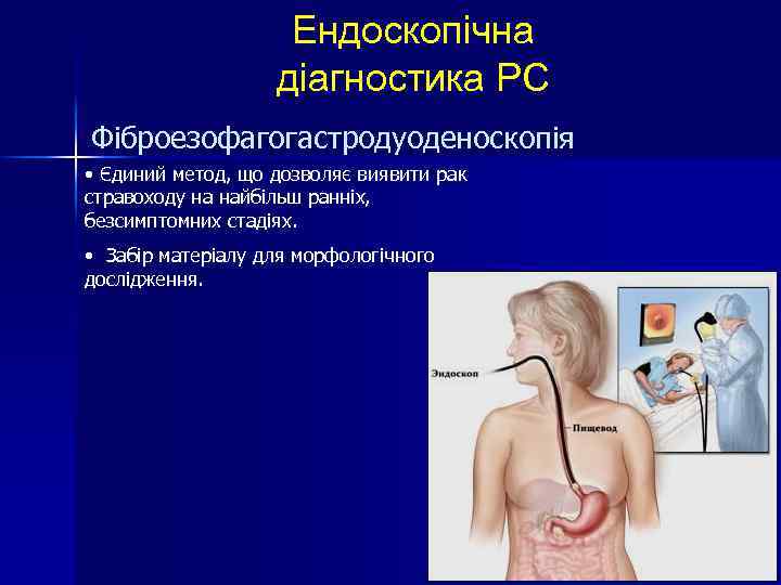 Ендоскопічна діагностика РС Фіброезофагогастродуоденоскопія • Єдиний метод, що дозволяє виявити рак стравоходу на найбільш