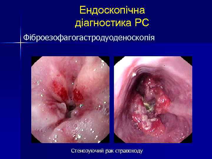 Ендоскопічна діагностика РС Фіброезофагогастродуоденоскопія Стенозуючий рак стравоходу 