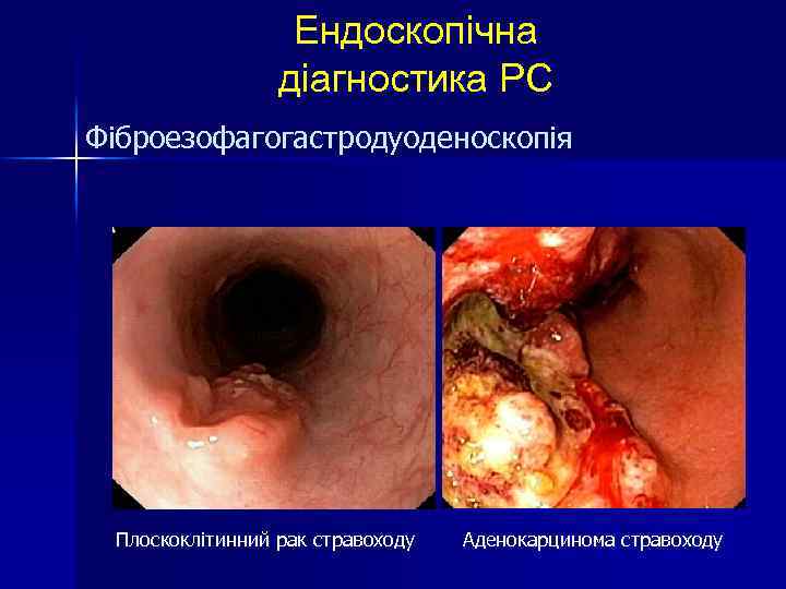 Ендоскопічна діагностика РС Фіброезофагогастродуоденоскопія Плоскоклітинний рак стравоходу Аденокарцинома стравоходу 