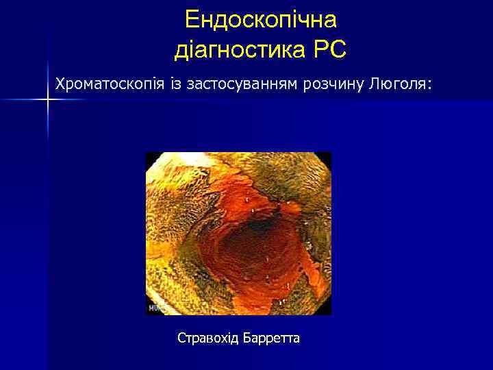 Ендоскопічна діагностика РС Хроматоскопія із застосуванням розчину Люголя: Стравохід Барретта 