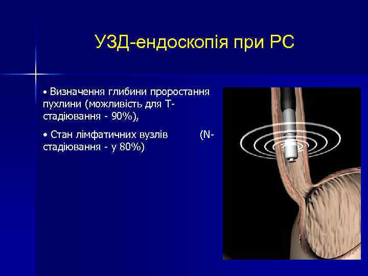 УЗД-ендоскопія при РС • Визначення глибини проростання пухлини (можливість для Tстадіювання - 90%), •