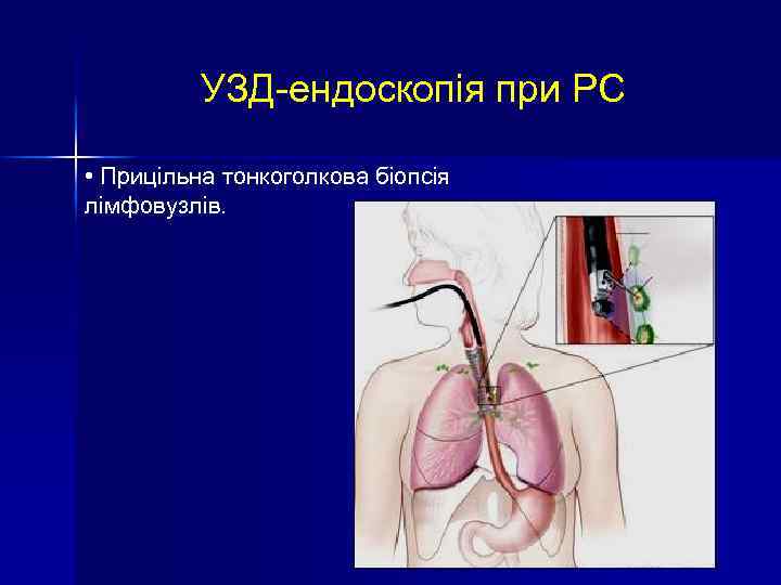 УЗД-ендоскопія при РС • Прицільна тонкоголкова біопсія лімфовузлів. 