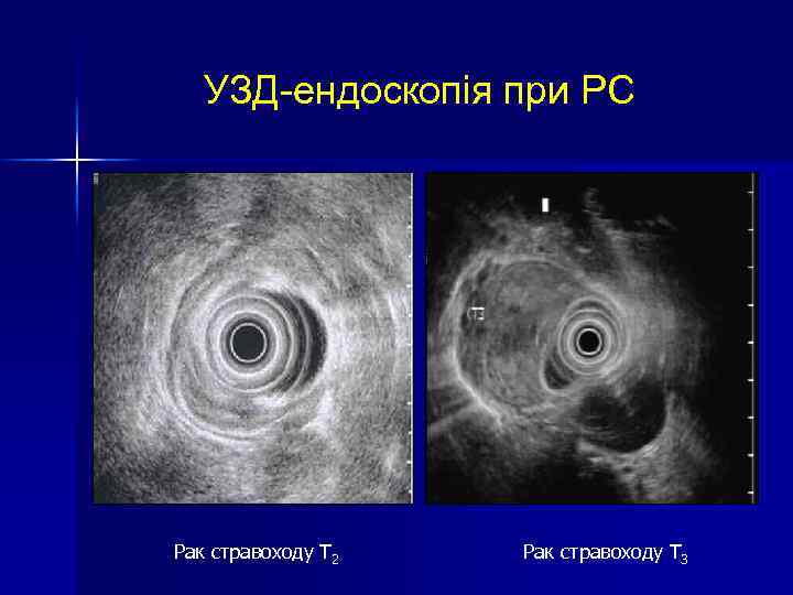 УЗД-ендоскопія при РС Рак стравоходу Т 2 Рак стравоходу Т 3 