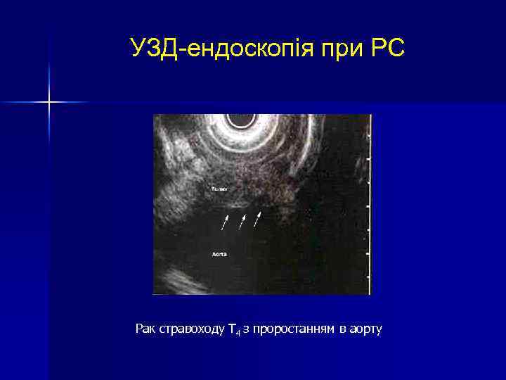 УЗД-ендоскопія при РС Рак стравоходу Т 4 з проростанням в аорту 