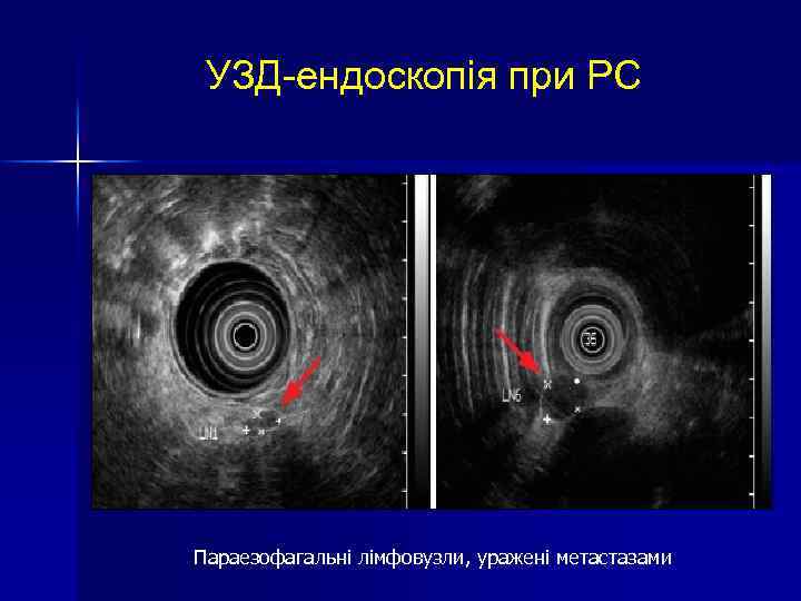 УЗД-ендоскопія при РС Параезофагальні лімфовузли, уражені метастазами 