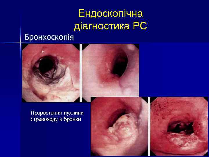 Бронхоскопія Ендоскопічна діагностика РС Проростання пухлини стравоходу в бронхи 
