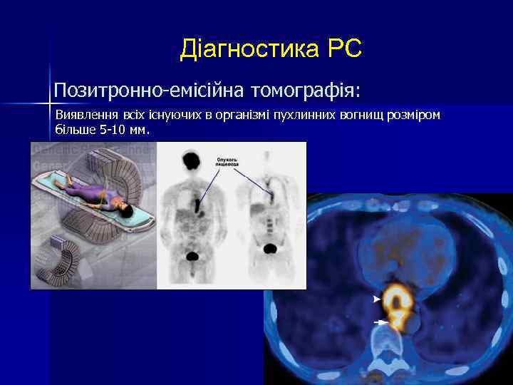 Діагностика РС Позитронно-емісійна томографія: Виявлення всіх існуючих в організмі пухлинних вогнищ розміром більше 5