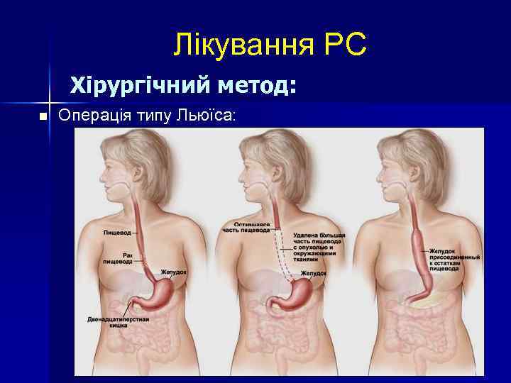 Лікування РС Хірургічний метод: n Операція типу Льюїса: 