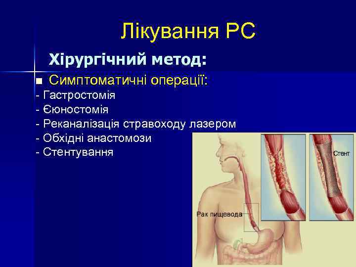 Лікування РС Хірургічний метод: n Симптоматичні операції: - Гастростомія - Єюностомія - Реканалізація стравоходу