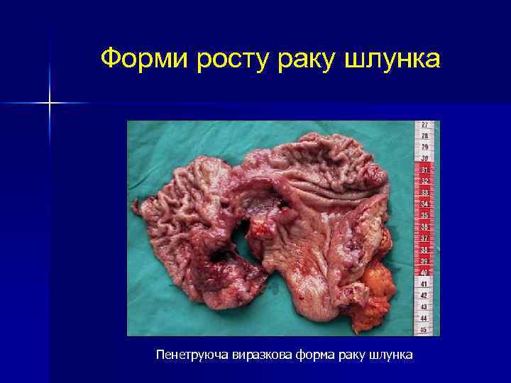 Форми росту раку шлунка Пенетруюча виразкова форма раку шлунка 