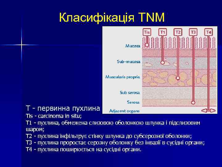 Класифікація TNM Т - первинна пухлина Тis - carcinoma in situ; Т 1 -