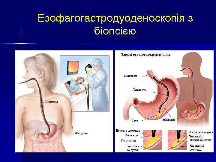 Езофагогастродуоденоскопія з біопсією 