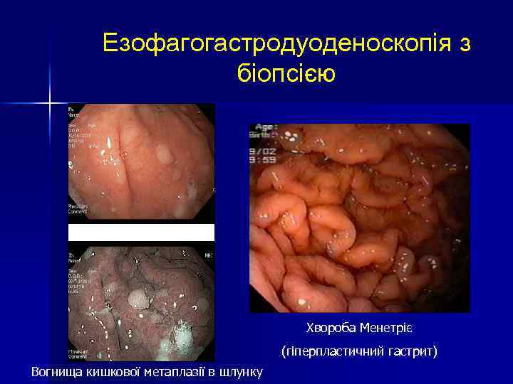 Езофагогастродуоденоскопія з біопсією Хвороба Менетріє (гіперпластичний гастрит) Вогнища кишкової метаплазії в шлунку 