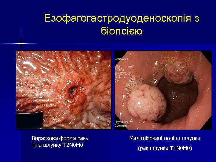 Езофагогастродуоденоскопія з біопсією Виразкова форма раку тіла шлунку T 2 N 0 M 0