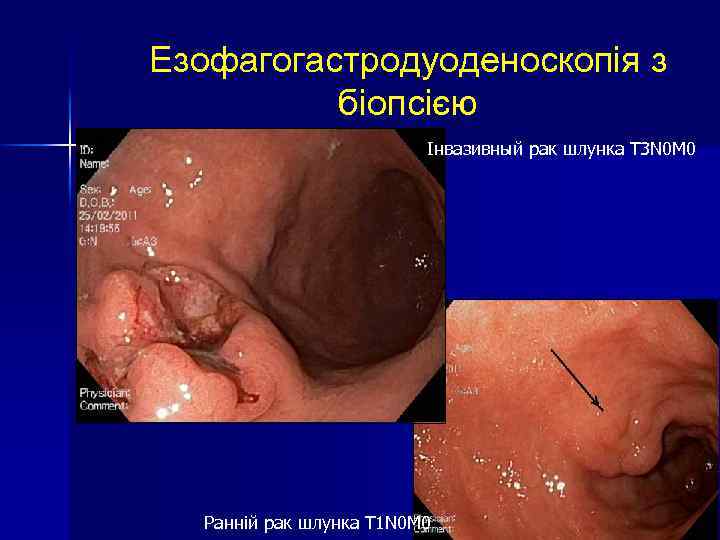 Езофагогастродуоденоскопія з біопсією Інвазивный рак шлунка T 3 N 0 M 0 Ранній рак