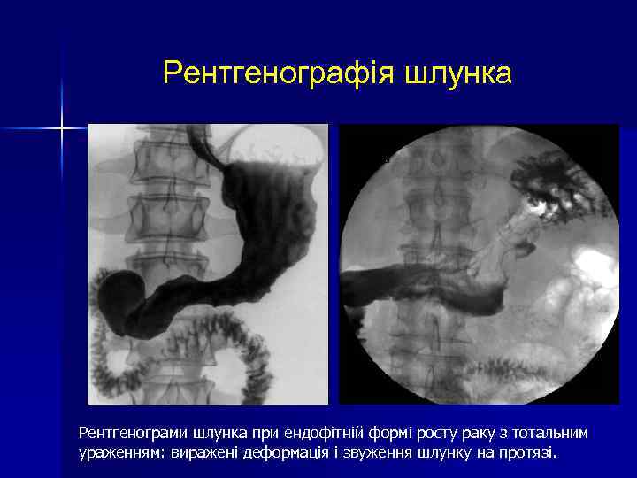 Рентгенографія шлунка Рентгенограми шлунка при ендофітній формі росту раку з тотальним ураженням: виражені деформація