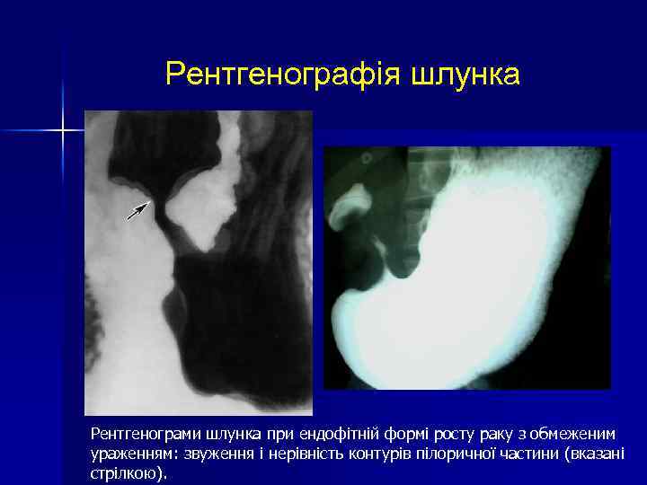 Рентгенографія шлунка Рентгенограми шлунка при ендофітній формі росту раку з обмеженим ураженням: звуження і