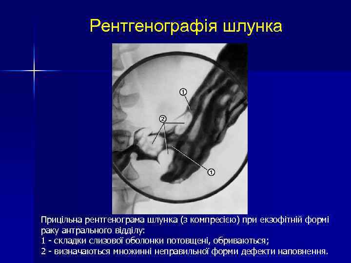 Рентгенографія шлунка Прицільна рентгенограма шлунка (з компресією) при екзофітній формі раку антрального відділу: 1