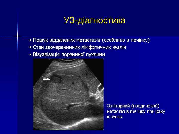 УЗ-діагностика • Пошук віддалених метастазів (особливо в печінку) • Стан заочеревинних лімфатичних вузлів •