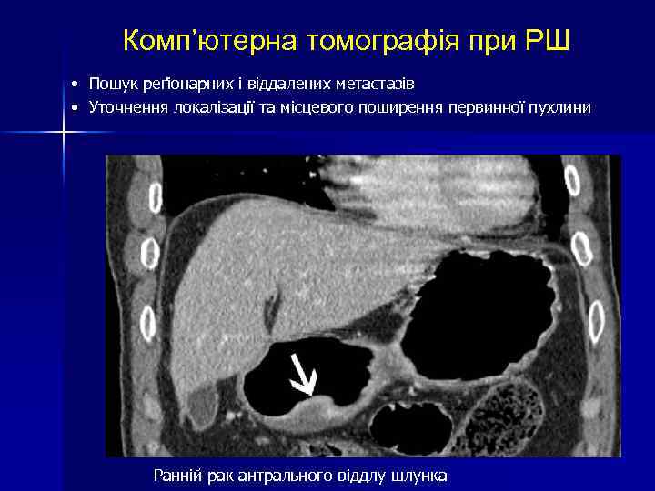 Комп’ютерна томографія при РШ • Пошук реґіонарних і віддалених метастазів • Уточнення локалізації та