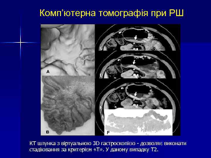 Комп’ютерна томографія при РШ КТ шлунка з віртуальною 3 D гастроскопією - дозволяє виконати