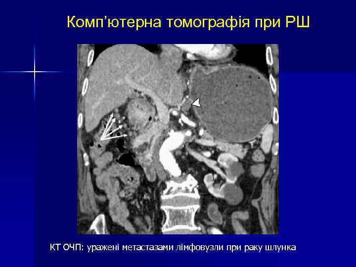 Комп’ютерна томографія при РШ КТ ОЧП: уражені метастазами лімфовузли при раку шлунка 