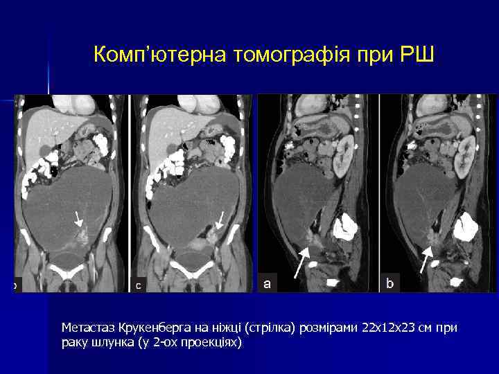 Комп’ютерна томографія при РШ Метастаз Крукенберга на ніжці (стрілка) розмірами 22 х12 х23 см