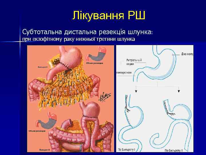 Лікування РШ Субтотальна дистальна резекція шлунка: при екзофітному раку нижньої третини шлунка 