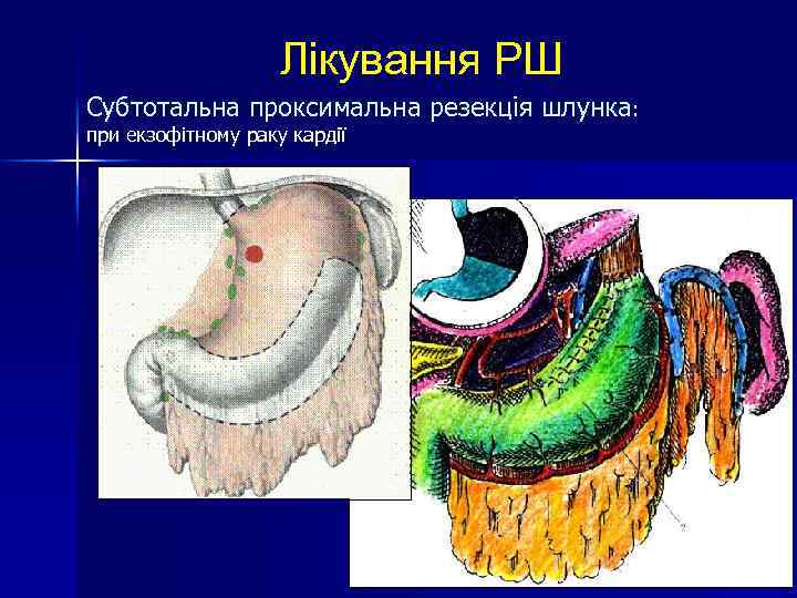 Лікування РШ Субтотальна проксимальна резекція шлунка: при екзофітному раку кардії 
