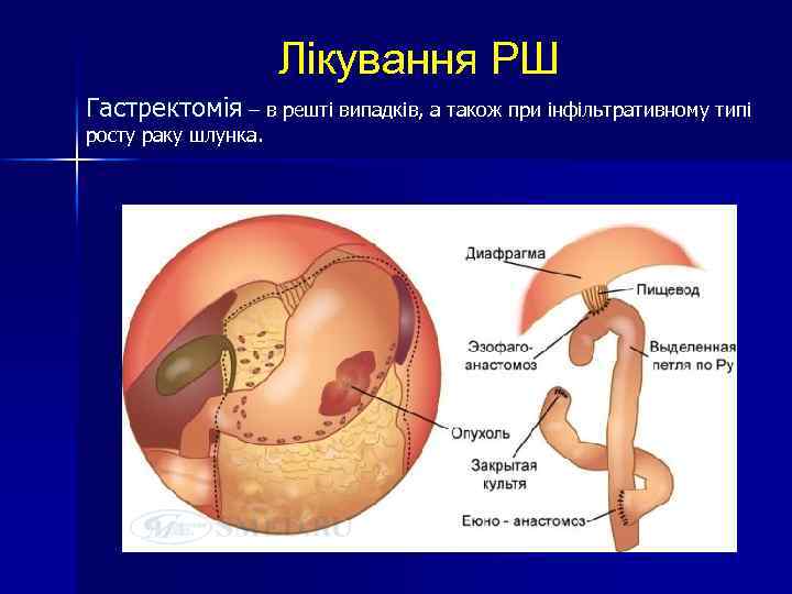 Лікування РШ Гастректомія – в решті випадків, а також при інфільтративному типі росту раку