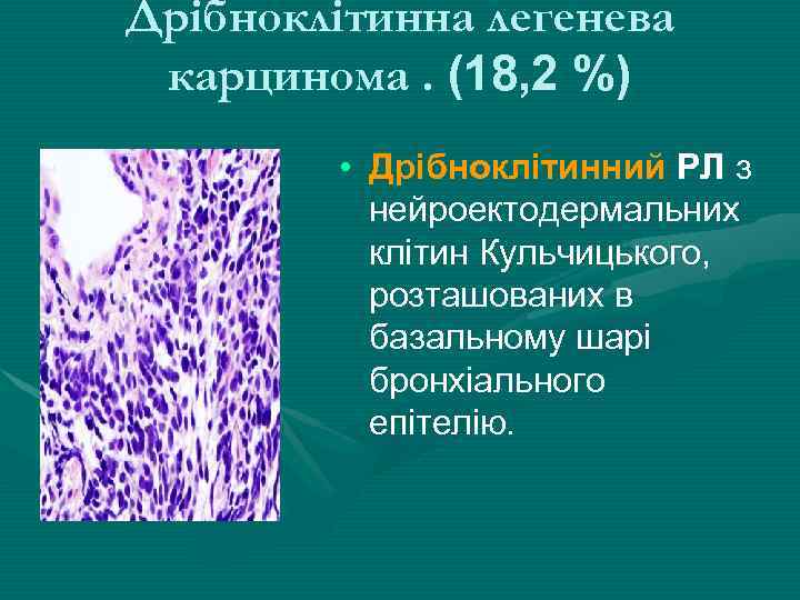 Дрібноклітинна легенева карцинома. (18, 2 %) • Дрібноклітинний РЛ з нейроектодермальних клітин Кульчицького, розташованих