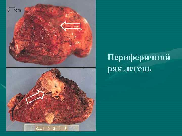 Периферичний рак легень 