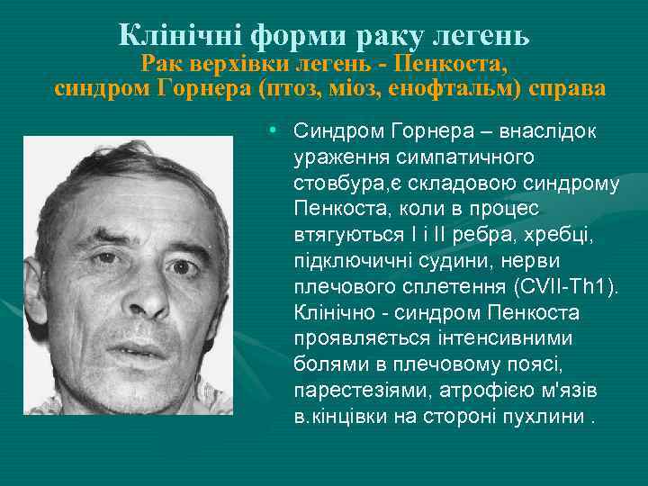 Клінічні форми раку легень Рак верхівки легень - Пенкоста, синдром Горнера (птоз, міоз, енофтальм)