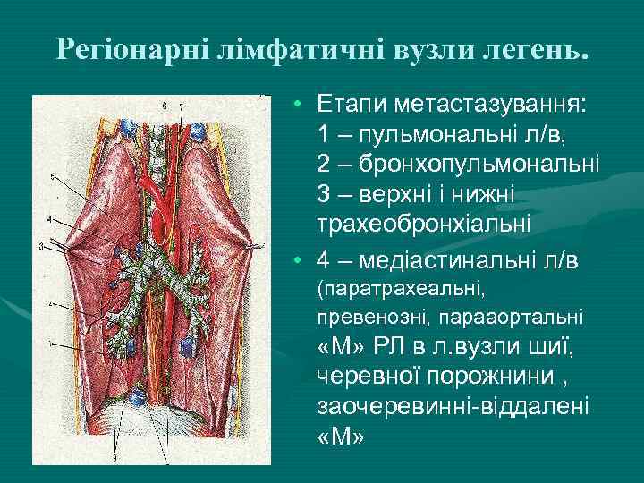 Регіонарні лімфатичні вузли легень. • Етапи метастазування: 1 – пульмональні л/в, 2 – бронхопульмональні