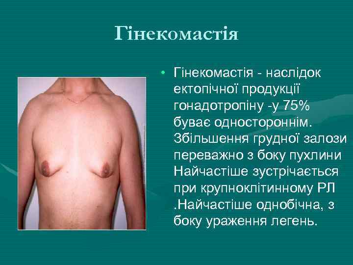 Гінекомастія • Гінекомастія - наслідок ектопічної продукції гонадотропіну -у 75% буває одностороннім. Збільшення грудної