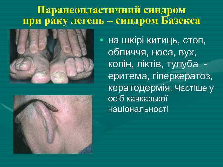 Паранеопластичний синдром при раку легень – синдром Базекса • на шкірі китиць, стоп, обличчя,