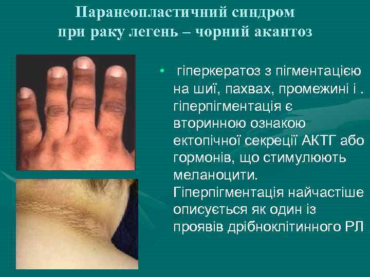 Паранеопластичний синдром при раку легень – чорний акантоз • гіперкератоз з пігментацією на шиї,