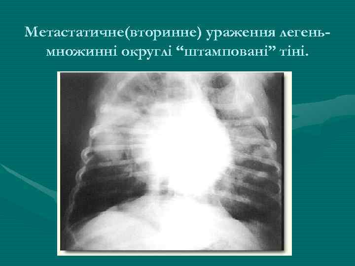 Метастатичне(вторинне) ураження легеньмножинні округлі “штамповані” тіні. 
