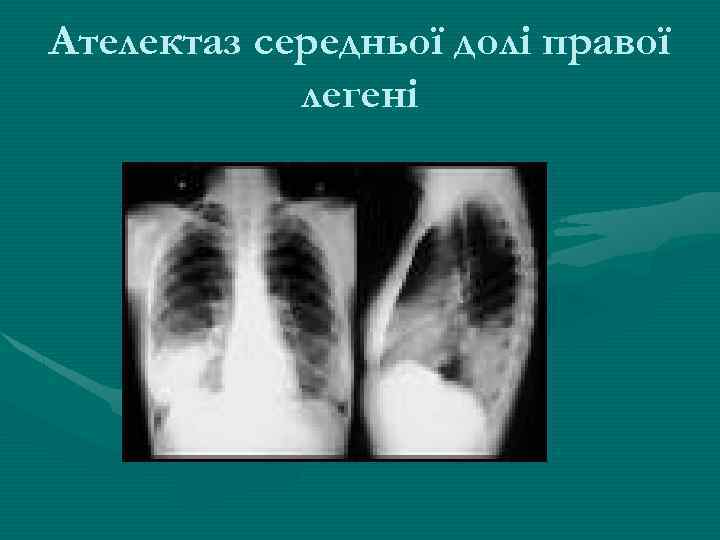 Ателектаз середньої долі правої легені 