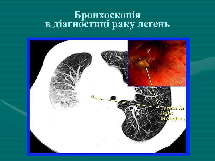 Бронхоскопія в діагностиці раку легень 